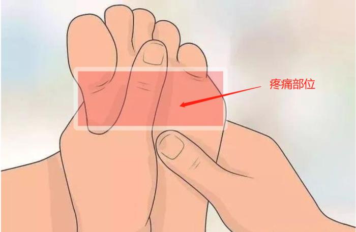 前脚掌疼痛通常考虑是 「跖痛症」.