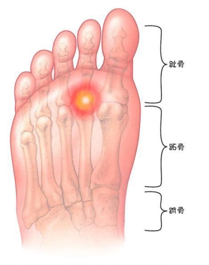 前脚掌疼痛通常考虑是「跖痛症」.