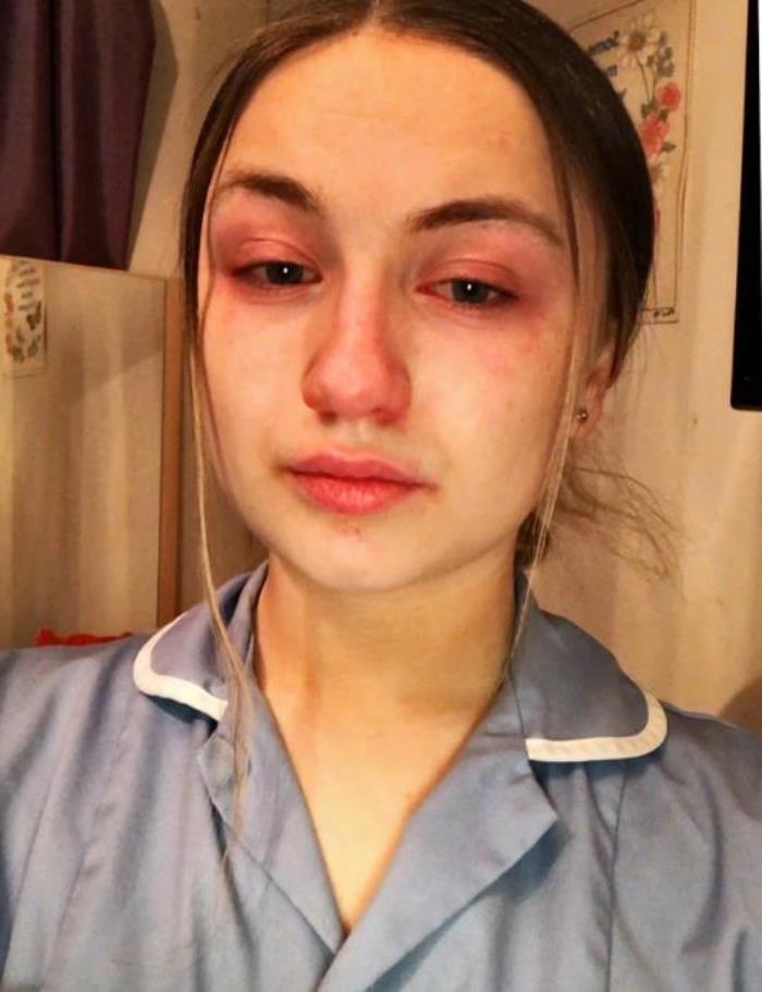真实眼睛哭红图片(英国护士值班13小时后哭红眼睛)