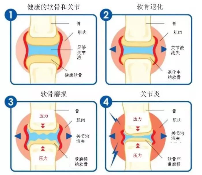 氨糖是关节软骨的重要营养素