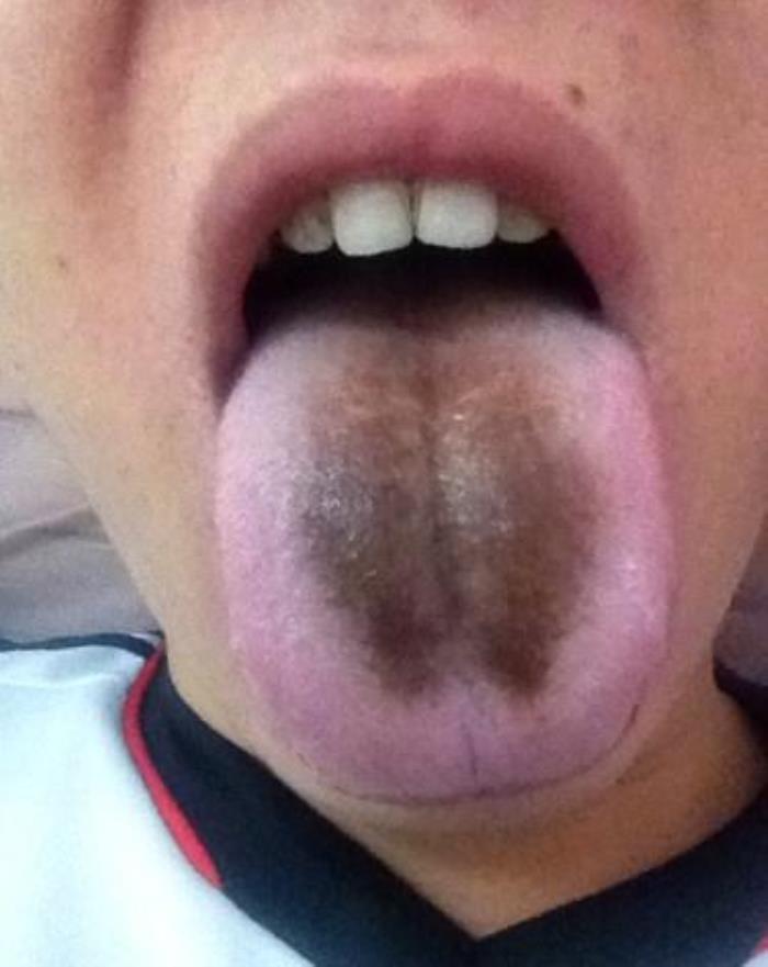舌苔发黑是什么病症舌苔发黑可不是好事