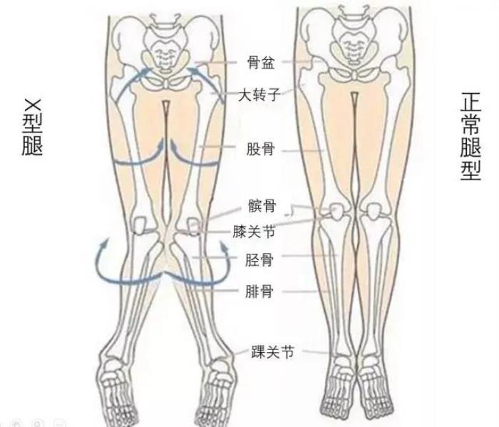 x型腿走路图解图片
